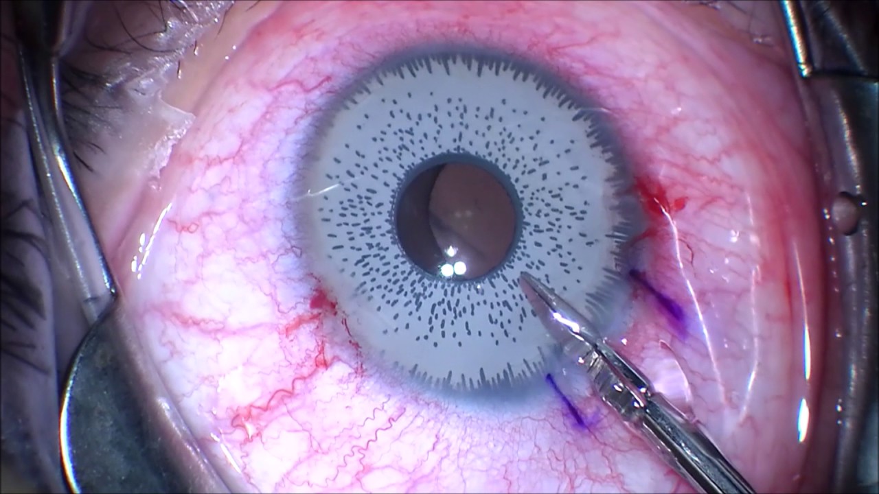Want to change your eye color Think twice.. Iris Implant Removal! J.T. Kavanagh MD. San Antonio TX
