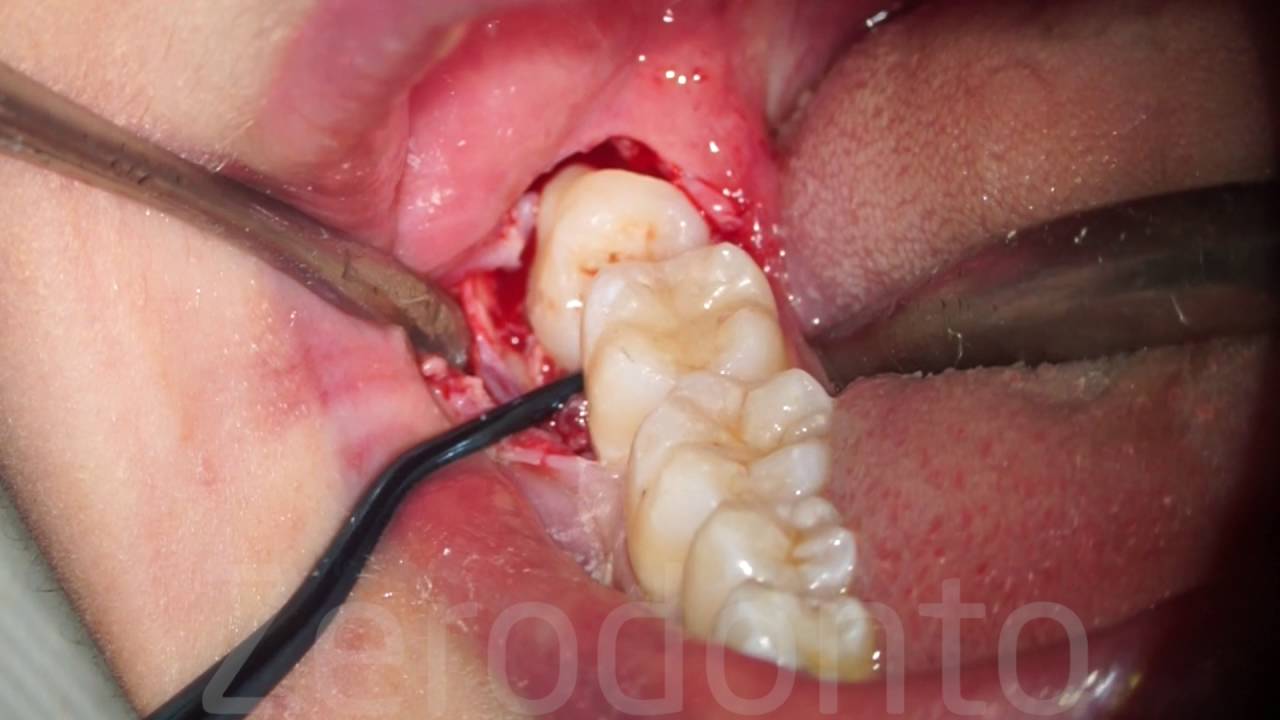 Horizontal semi-impacted wisdom tooth (sonic vs piezosurgery) - Dr. Fabio Cozzolino | Zerodonto