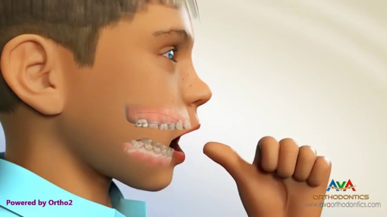 Thumb Sucking Habit Breaker - Orthodontic Device