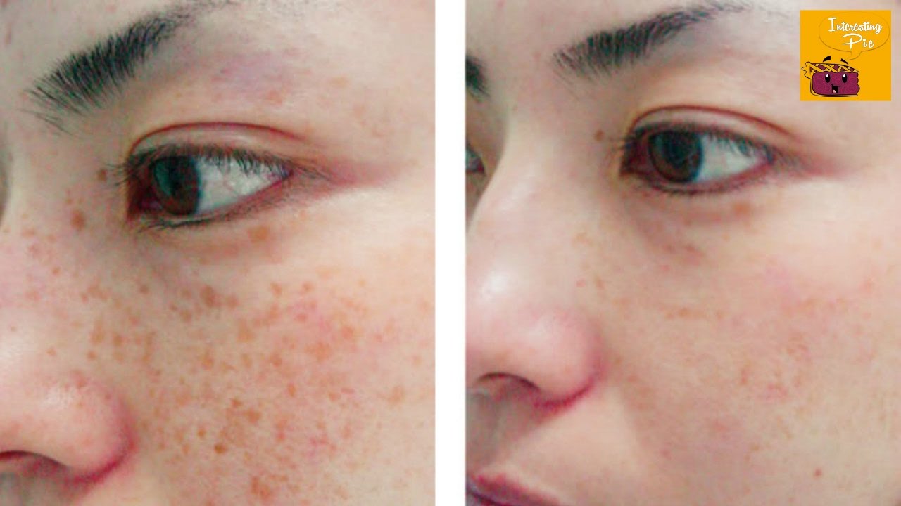 Amazing Freckles Removing Homemade Solution - 100% Results!