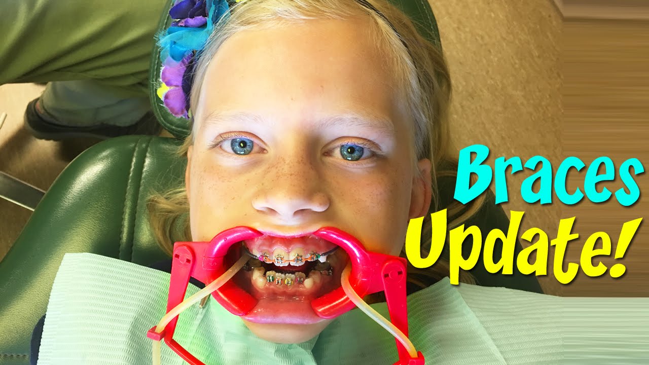 Alyssa Gets Tongue Tamers || Braces Update