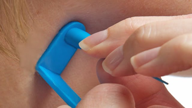 How to Remove Skin Tags Fast with TagBand