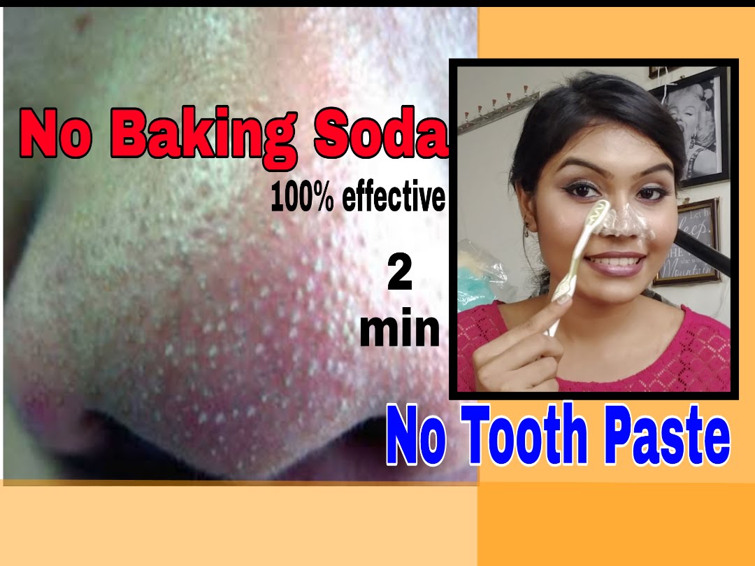 Remove BLACKHEADS / WHITEHEADS at home in just 2 minutes | best & easy | no baking soda